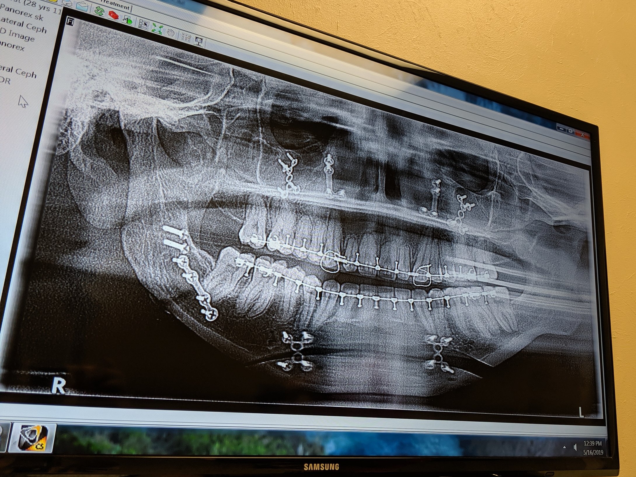 Here you will see my what my jaw looks like post-op. The have completely removed my left joint for now, broken and aligned both my chin and lower jaw, and impacted my upper jaw and secured it all with several screws. No more easy TSA checks for me.  😆
