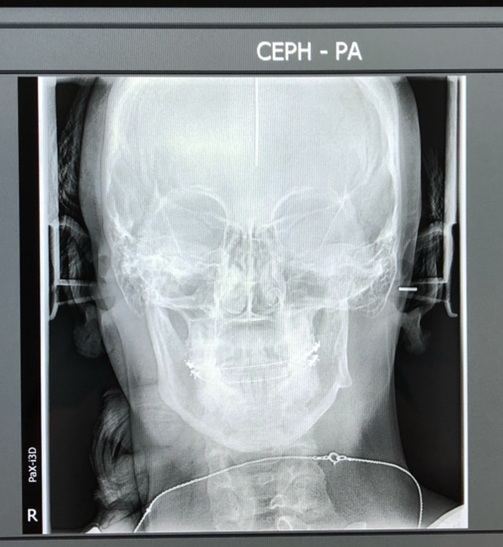 My very first x-rays. You can see here how my left joint is shorter than the right &amp; my entire jaw was “canted” or tilted. This caused severe pain, difficultly chewing, neck issues, headaches, &amp; lock-jaw. All TMJ symptoms,